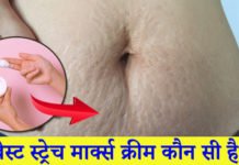बेस्ट स्ट्रेच मार्क्स क्रीम – 6 Best Stretch Marks Cream बेस्ट स्ट्रेच मार्क्स क्रीम - 6 Best Stretch Marks Creams