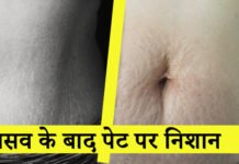 प्रसव के बाद पेट पर निशान – Pregnancy Stretch Marks प्रसव के बाद पेट पर निशान – Pregnancy Stretch Marks
