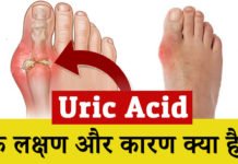 यूरिक एसिड के लक्षण और कारण क्या है? – 10 symptoms and causes of uric acid? यूरिक एसिड के लक्षण और कारण क्या है?